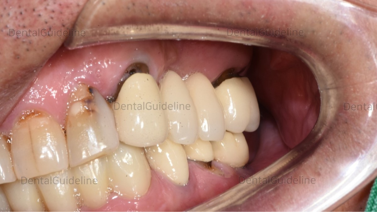 Apical surgery. Apicoectomy > DENTAL FORUMS DentalGuideline