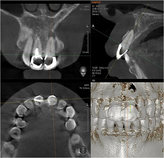 CBCT. Left central incisor had a apical lesion.