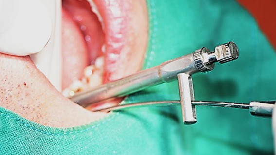 torque value after  insertion