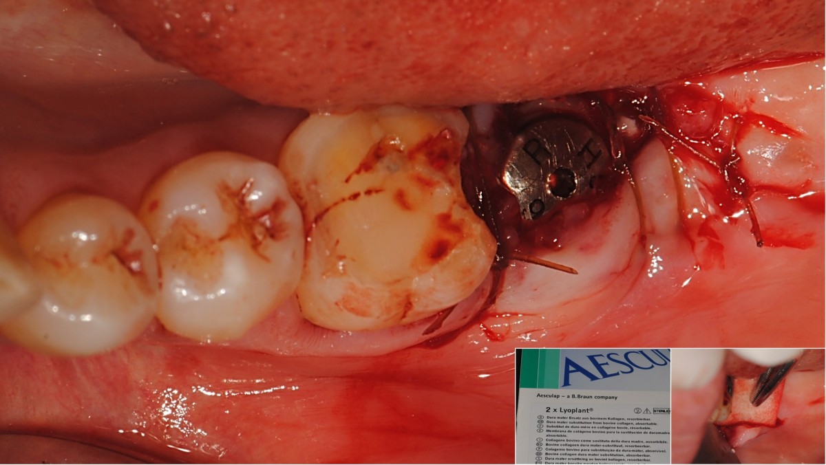 A collagen membrane was placed over the GBR area and sutured.