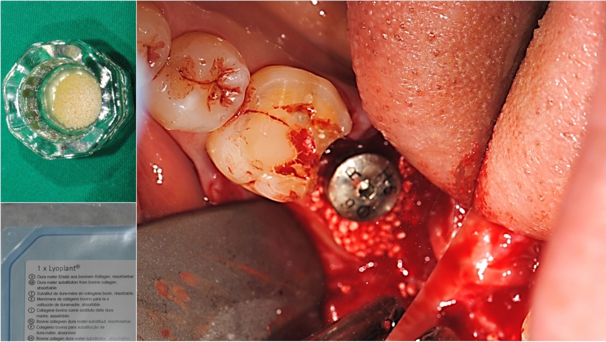 The extraction area was filled with bovine bone to a fairly solid level.
