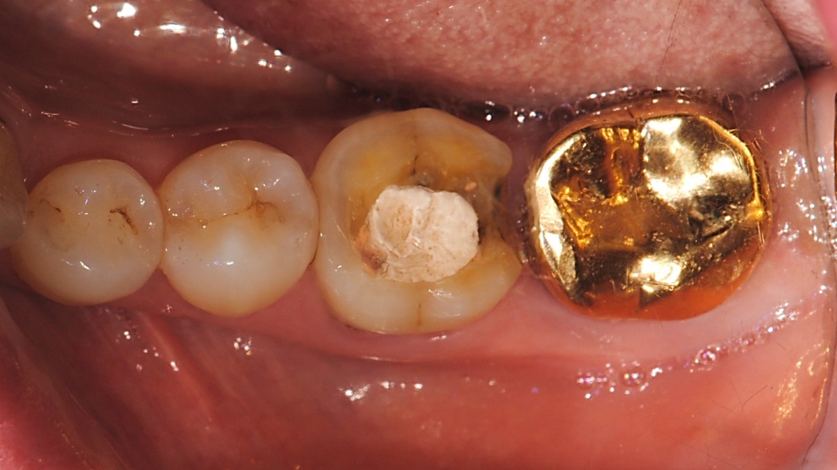 Intraoral photo. fold-crownef tooth is scheduled to be pulled out and implamt installation.