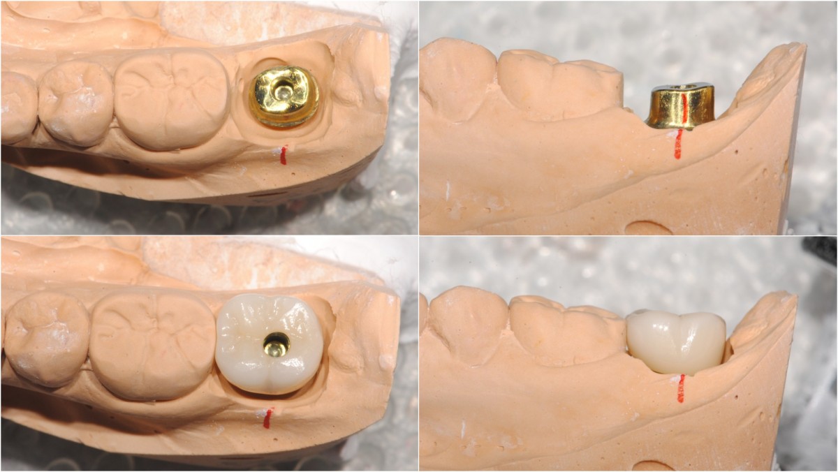 restoration - custom abutment and zirconia crown.