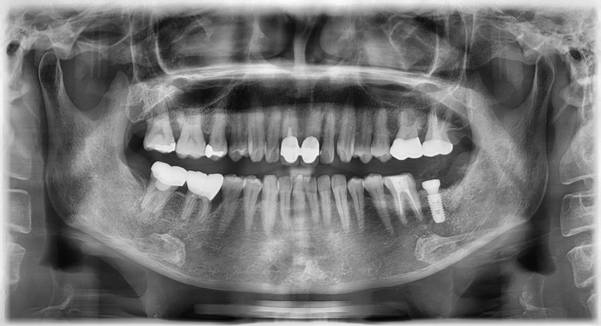 Post-op Panoramic view