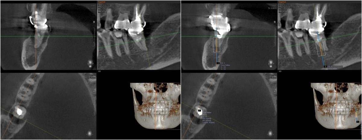 Simulation on the CT image