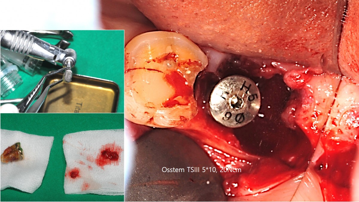 tooth extraction, immediate placement, An attempt was made to implant a 4.5 mm diameter implant, but initial fixation was not good, so it was replaced with a 5 mm diameter implant.