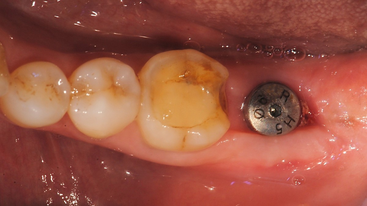 intraorall photo. 2.5 months after the surgery.