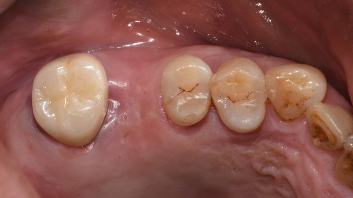 4 months after sinus graft.  Intra-oral view on the day of implant surgery. It was scheduled that the 2nd molar extraction and 2 implants would be placed in the 1st and 2nd molar zone.