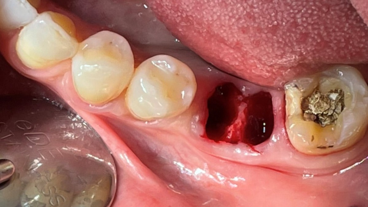 serial drilling was performed in the socket of the  mesial root.