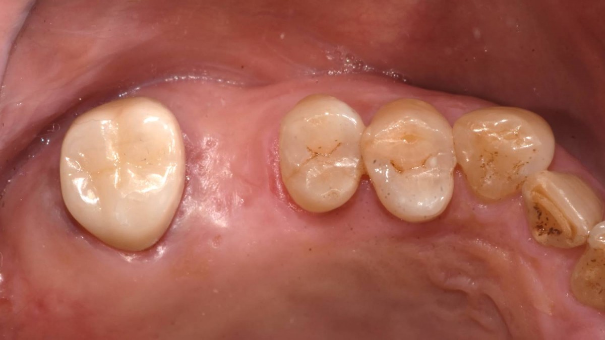 Intraoral view before the maxillary sinus graft