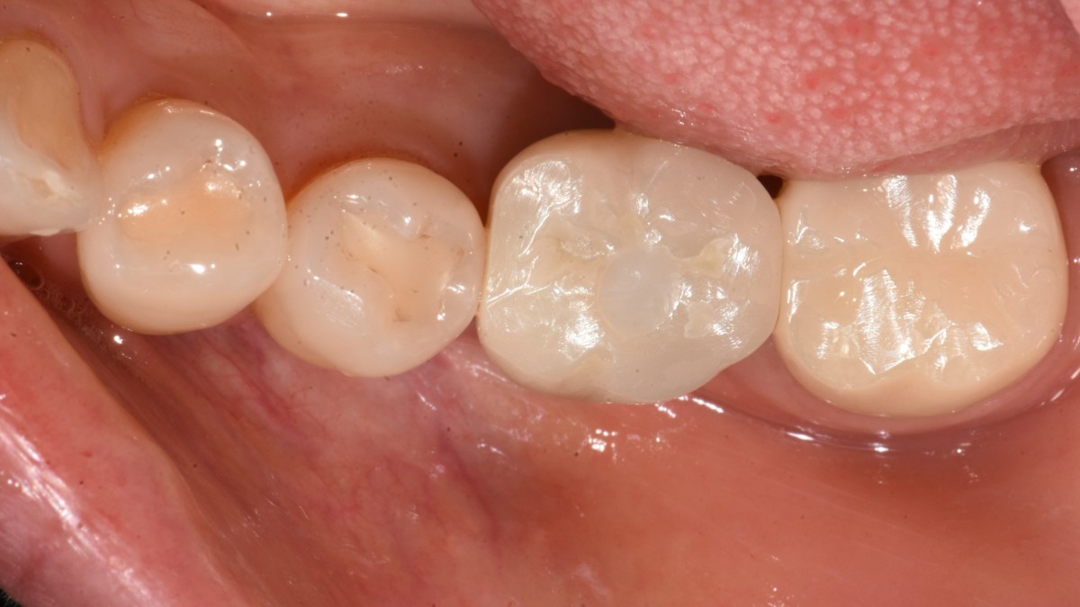 Final cementation and access hole filling with composite resin.