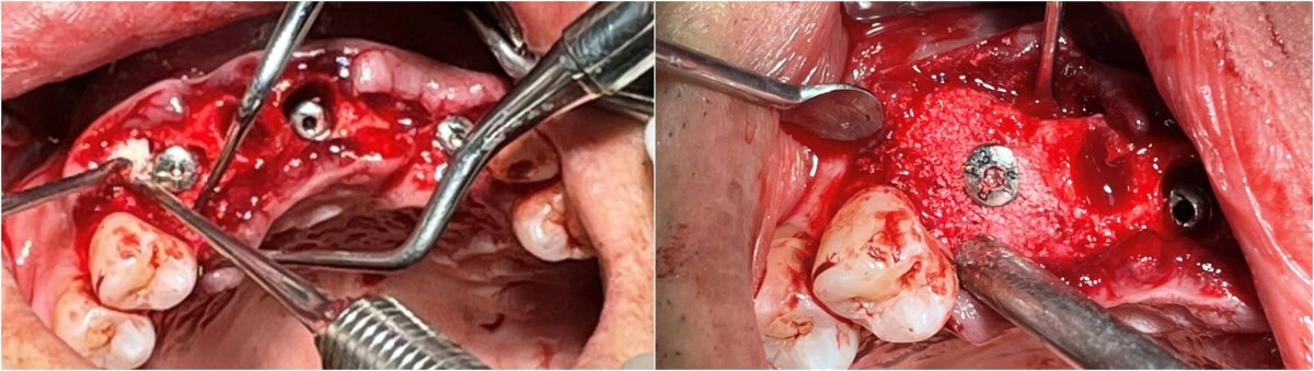 right canine area - Arum Dentistry 4.5*11.5,  right central incisor - Arum Dentistry 3.8*10, lleft ateral incisor - DIO 3.3*11.5.
