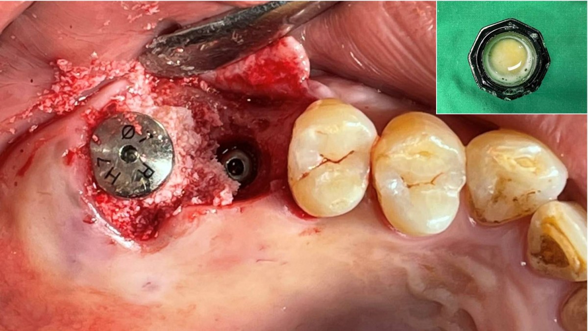 GBR was performed at the immediately placed area. Xenogrtaft+CGF