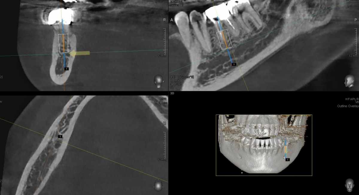 CBCT and placement simulation