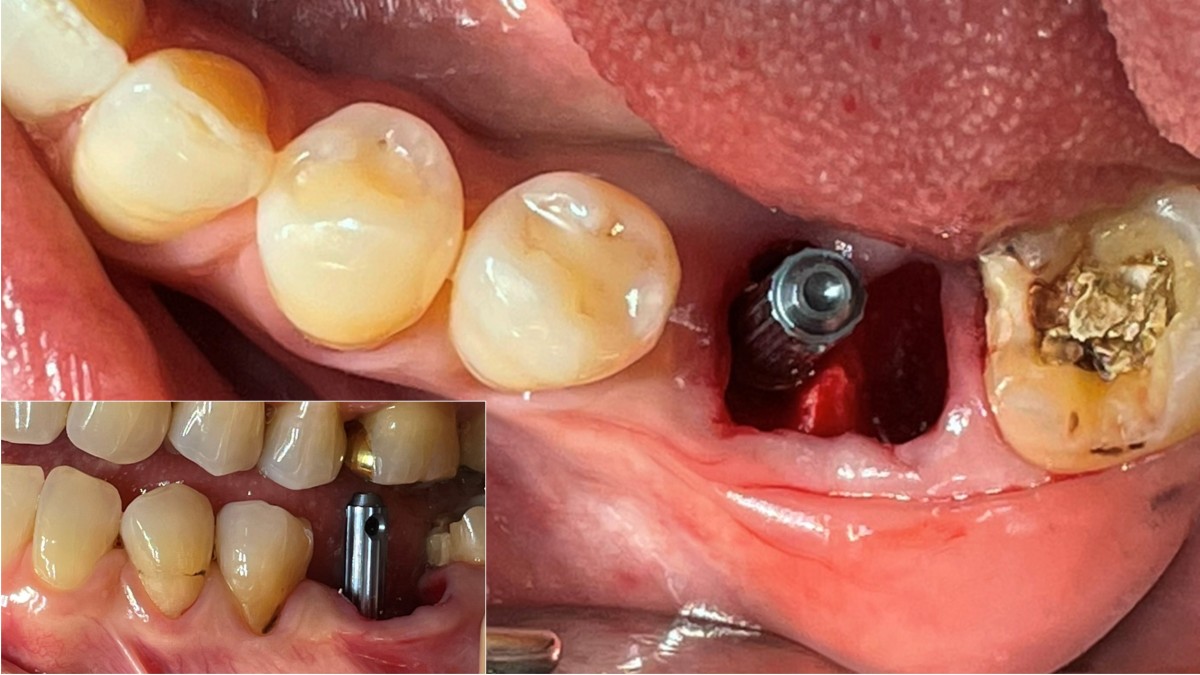 A direction pin was used  to verify the mesiodistal, buccolingual, and relative position to the opposing dentition.