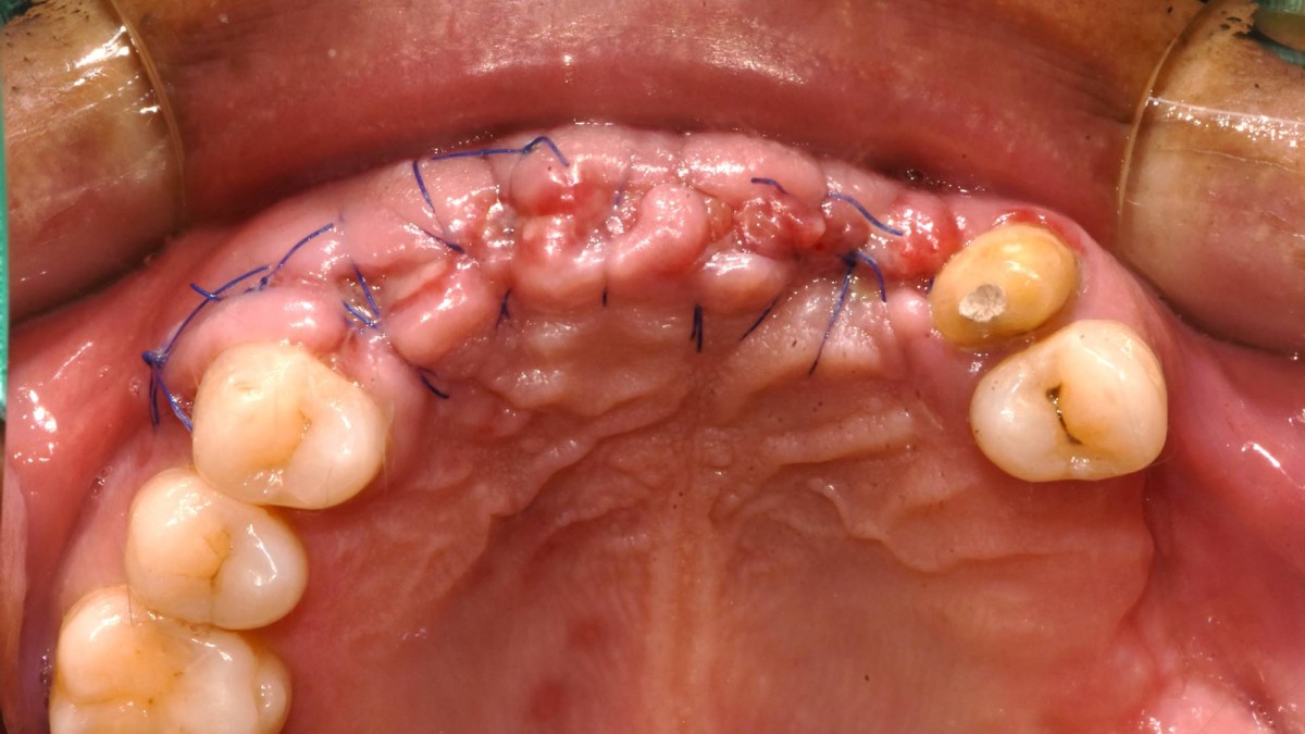 1 week after implant surgery