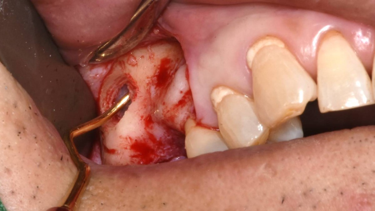 Sinus membrane elevation procedure with all-in-one sinus curette.