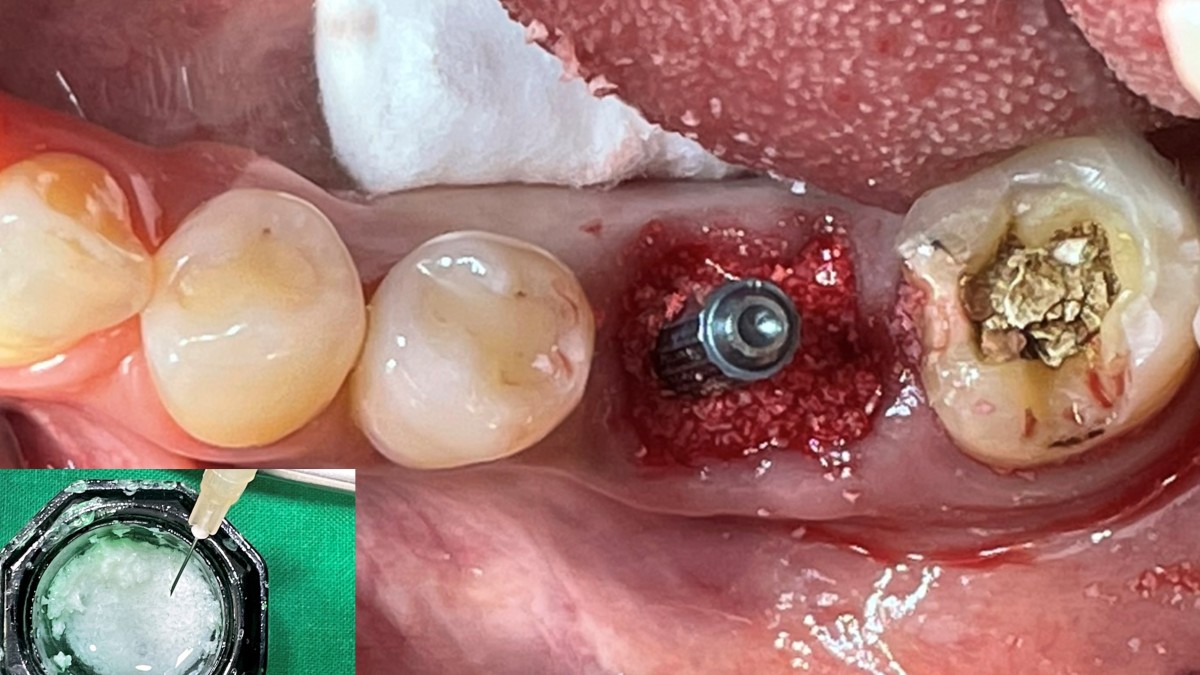 GBR was performed (Xenograft).