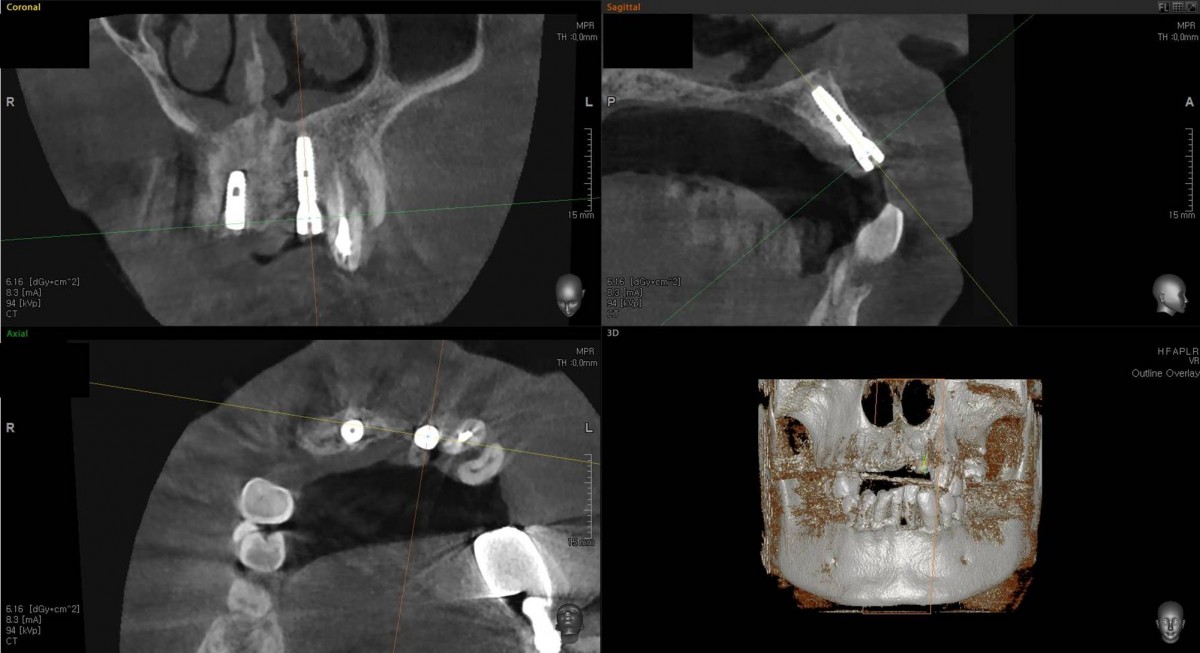 Lateral incisor zone.