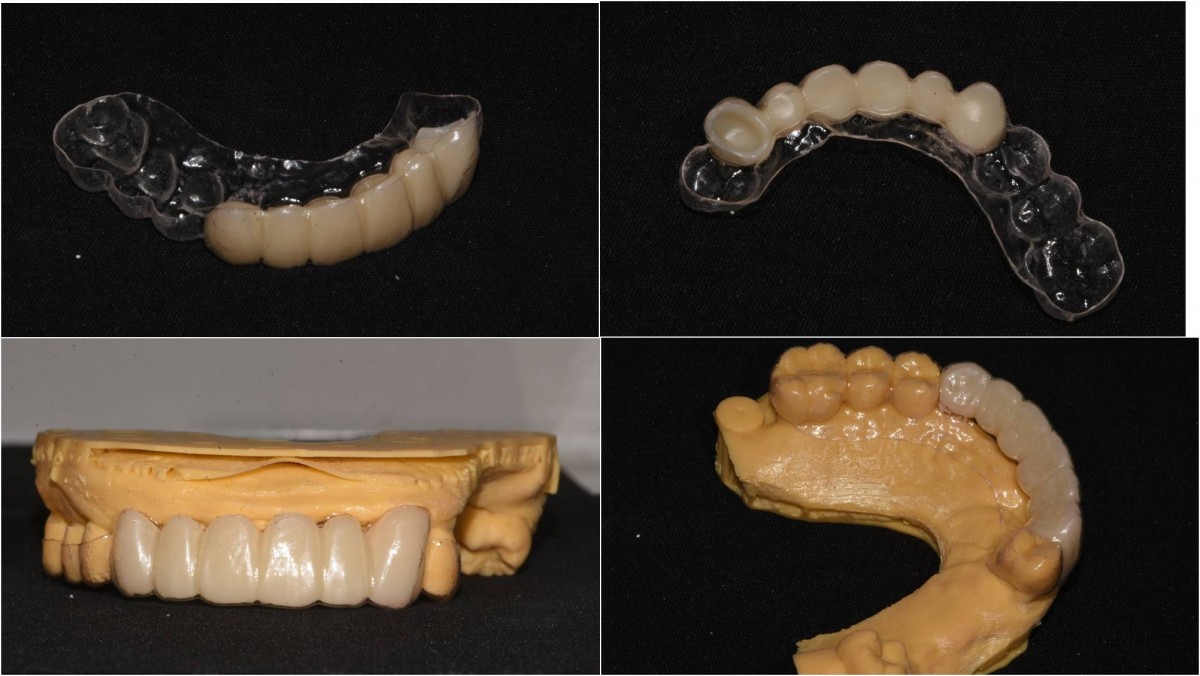 Instead of a flipper, suck-down shell with resin pontic.