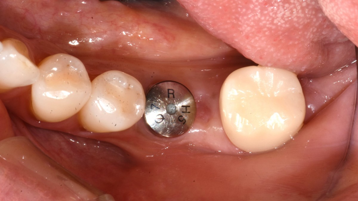 2 months post-op on the day ISQ check
