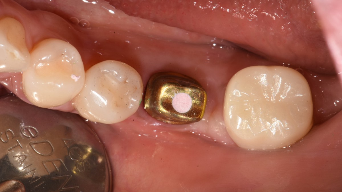 The abutment was connected and the screw hole was filled with a temporary filling material.