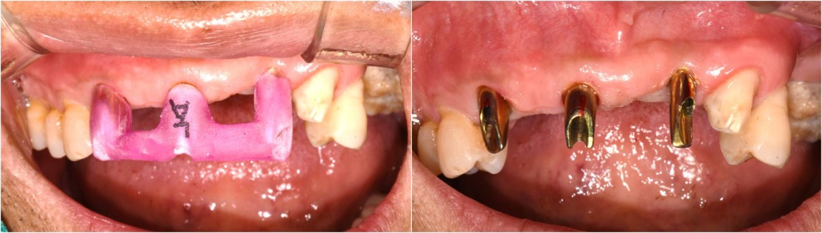 Custom abutments were connected. Seating jig. If necessary, the abutment can be conveniently connected by using a seating jig.