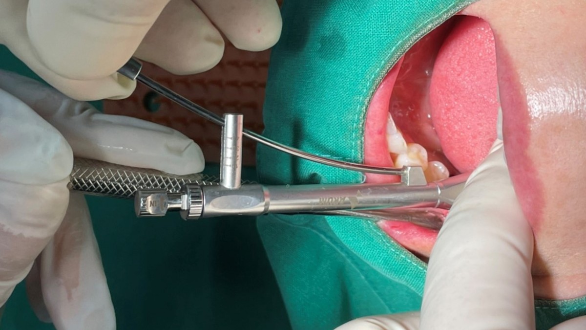 Final seating of fixture. The torque value showed 40Ncm.