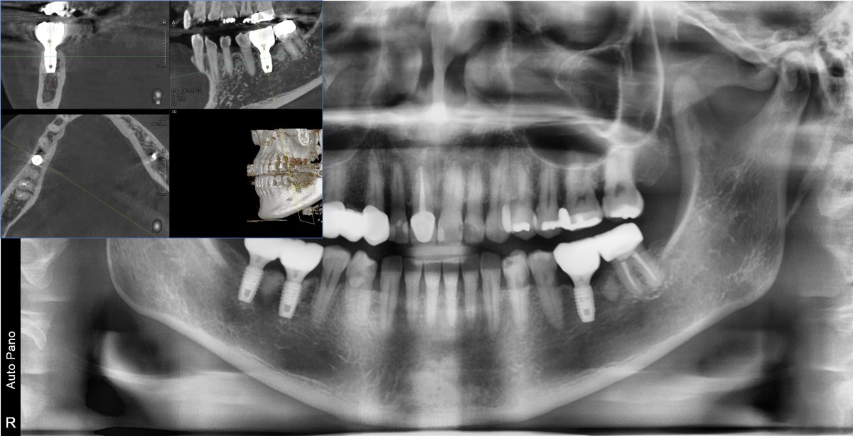 31 months after loading