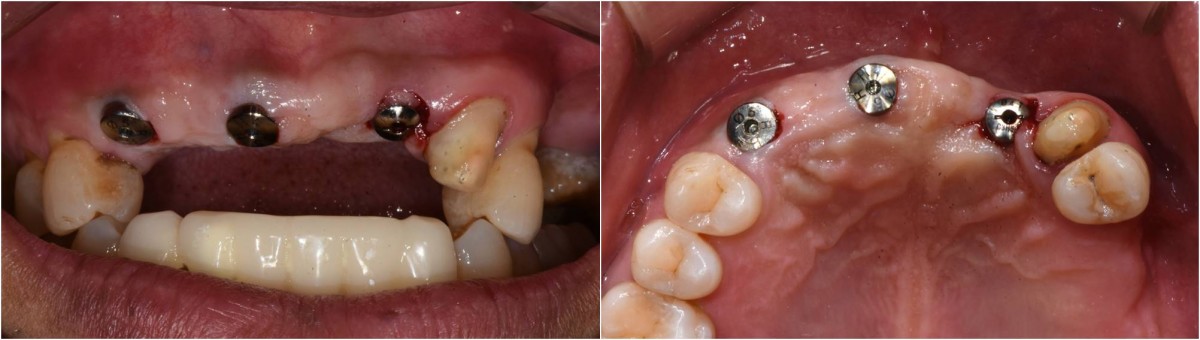 2nd surgery was performed.