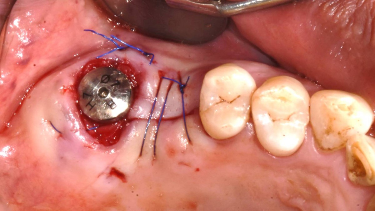 The flap was closed.