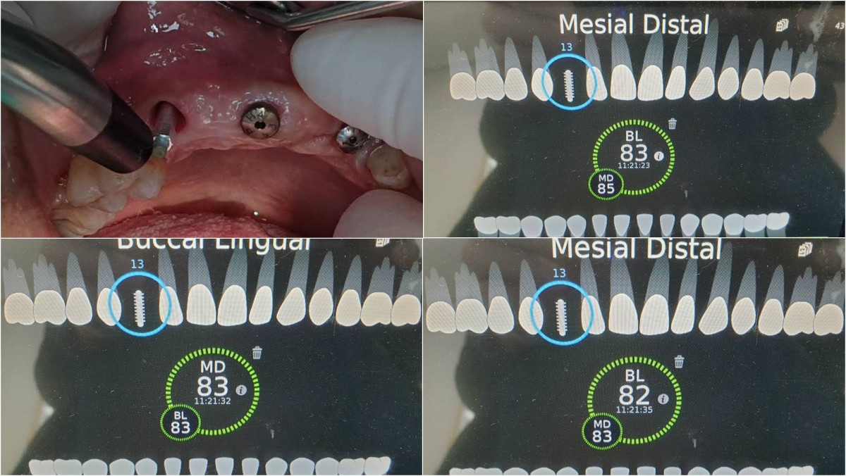 The ISQ values were checked on the second surgery day.