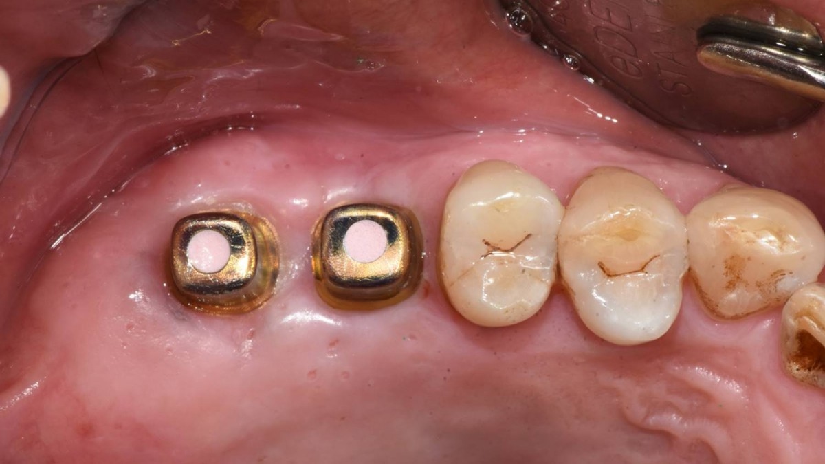 Abutments were connected to fixtures
