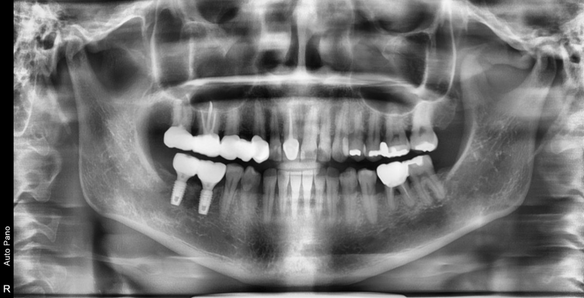 pre-op panoramic view