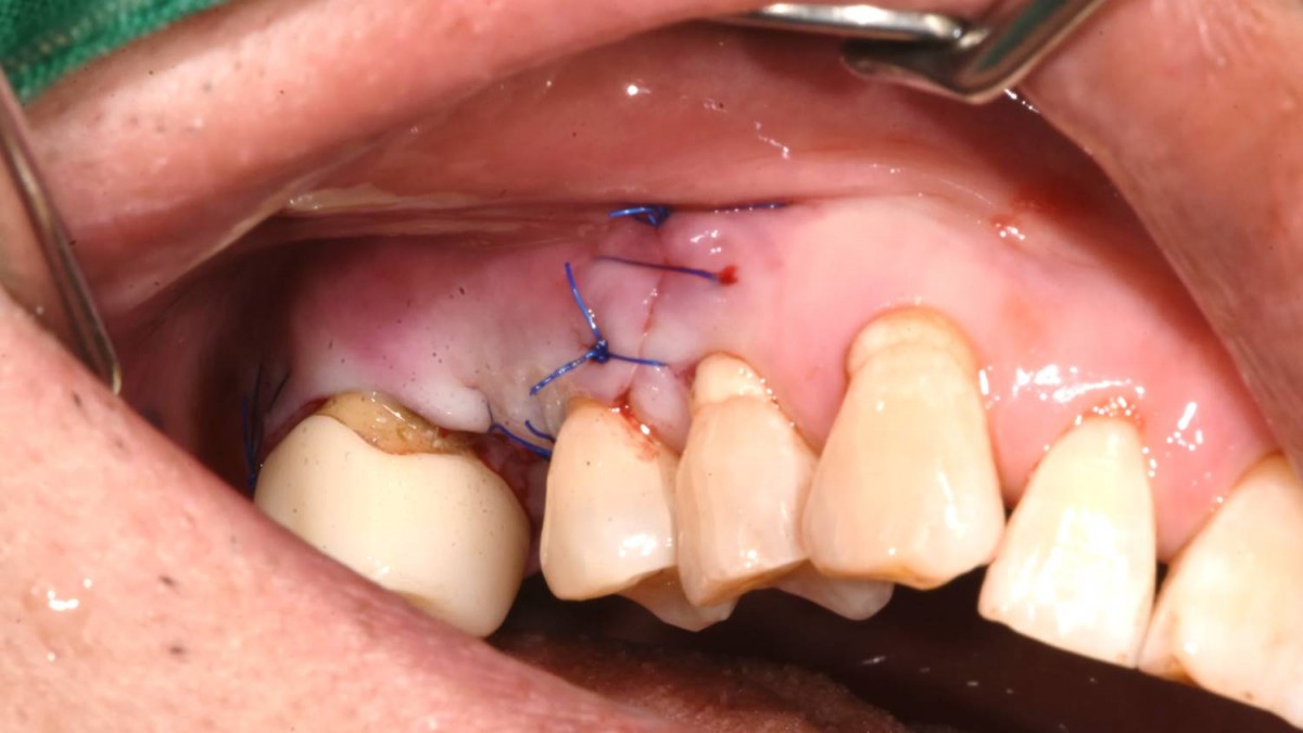 Suture was done (Nylon 4-0)