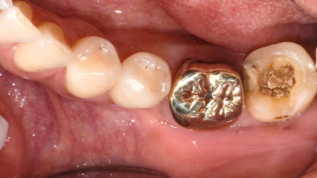 Pre-op intraoral view