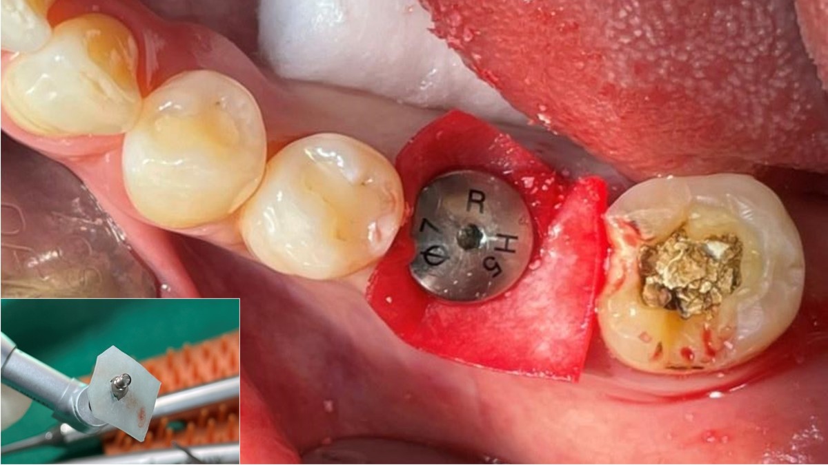A healing abutment holding a collagen membrane was screwed into the fixture.