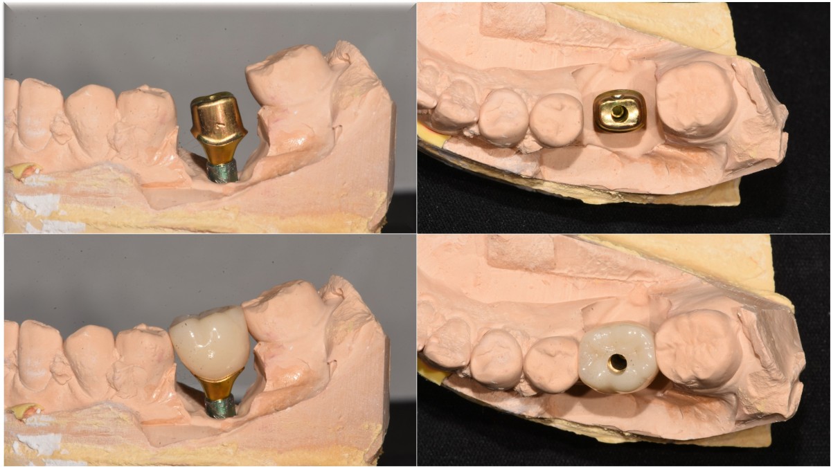 Custom abutment and zirconia crown.