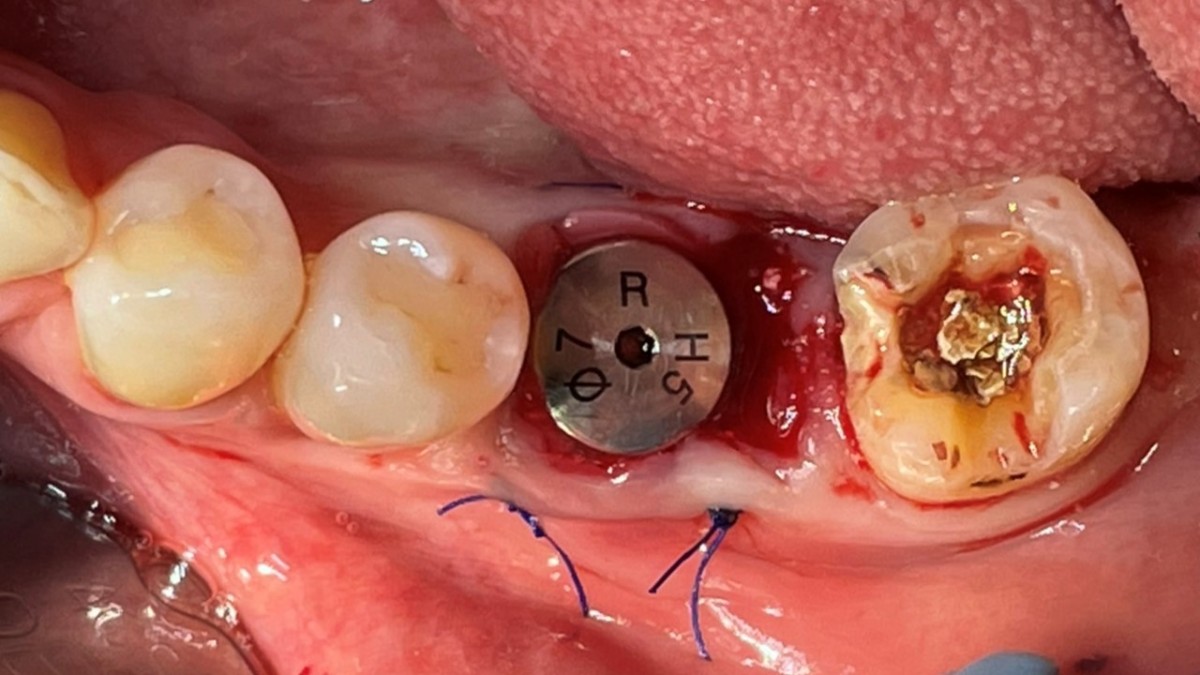 The suture was given to prevent the membrane evulsion.