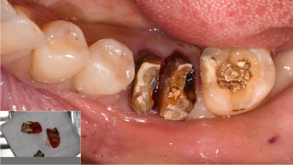 hemisection after crown removal.