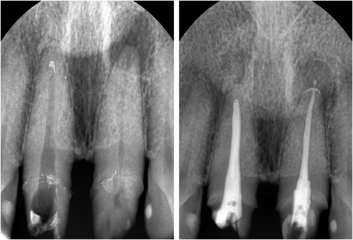After diagnosis, the patient decided to undergo treatment for periapical lesions.
