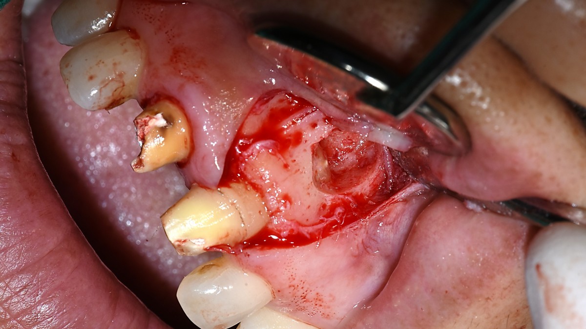 Apical resection performed one week after root canal treatment   