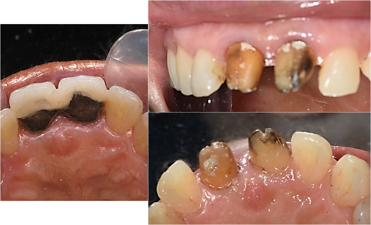 Initial photo and old crown removal.