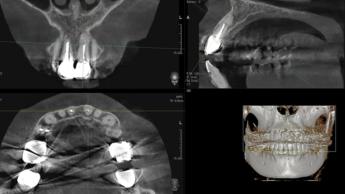 CBCT. 6 years after the apicoectomy.