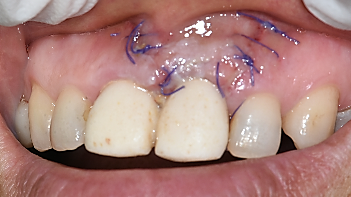 2 weeks after the apicoectomy.