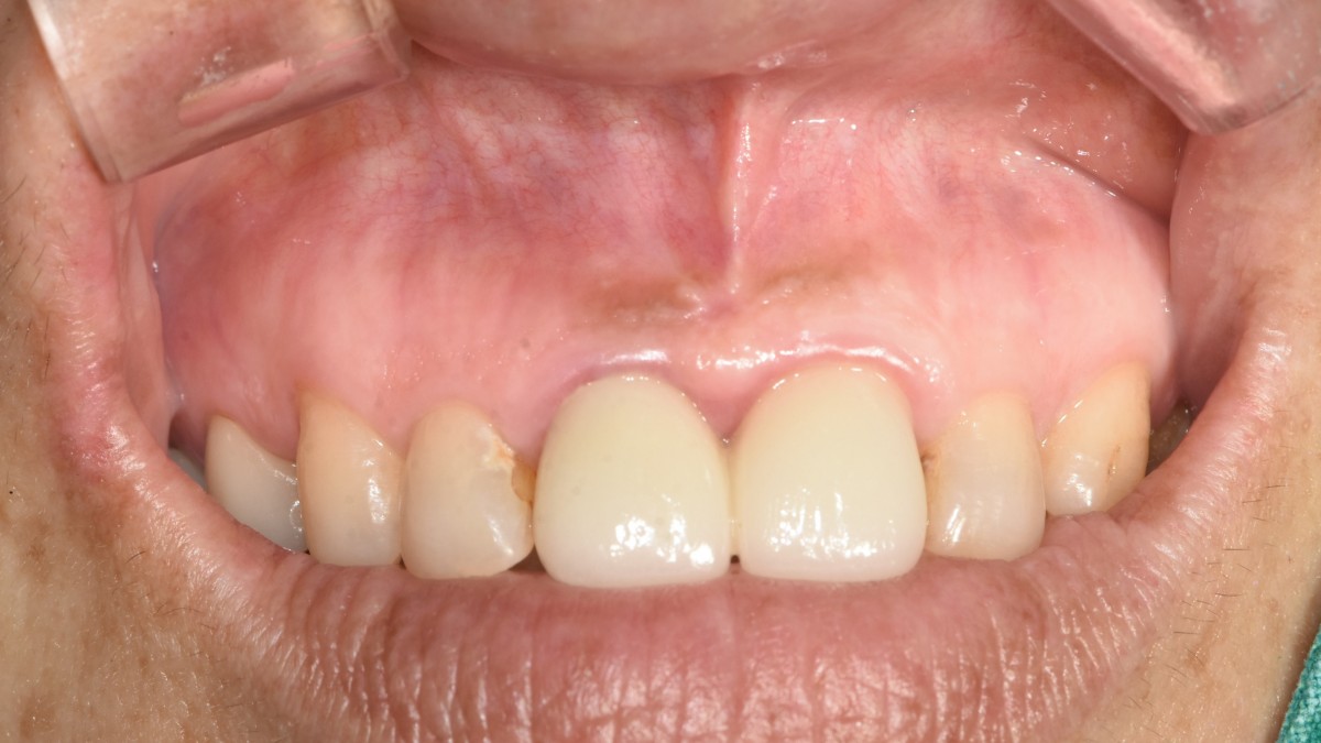 Intraoral photo. 6 years after the apicoectomy.