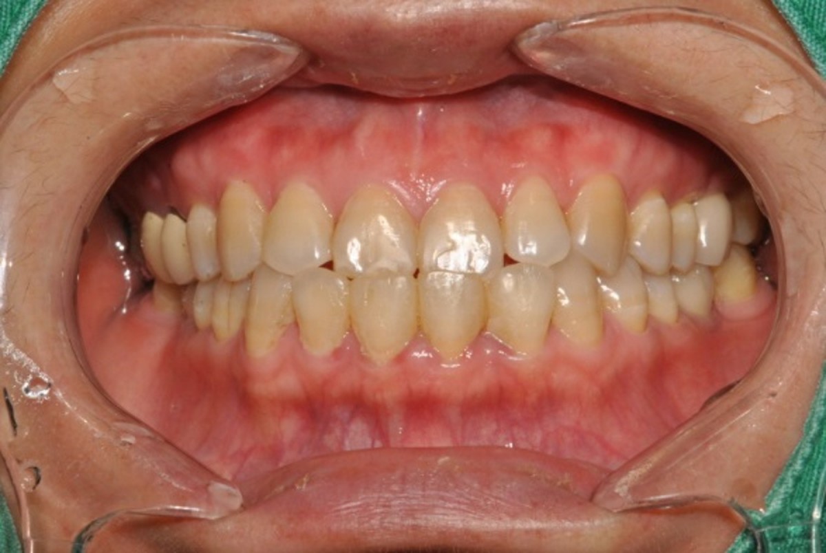 Initial view (crossbite)