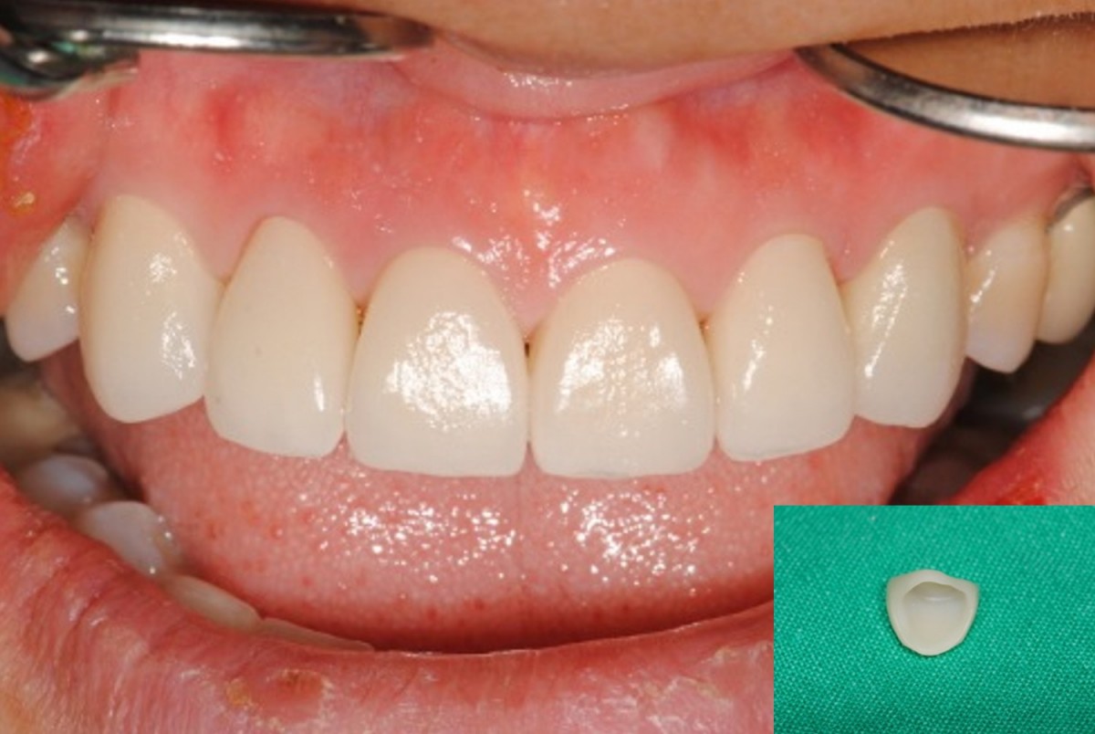 Upper anterior restoration