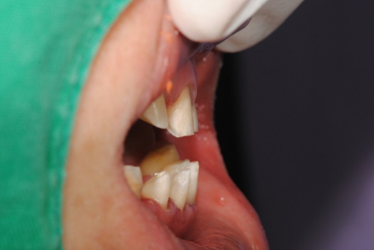 CHecking the anterior relation during the preparation.