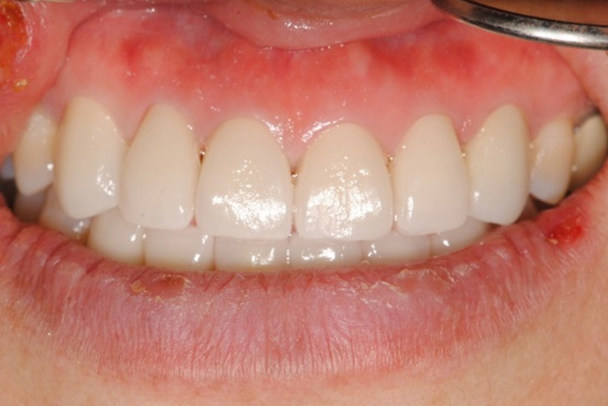 Anterior restoration to a normal occlusion.